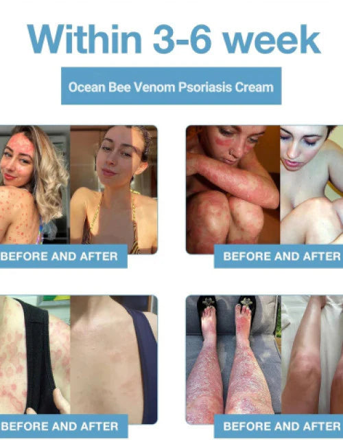 Bee Venom &Ocean Psoriasis Healing Cream ( BUY 1 GET 1 FREE )